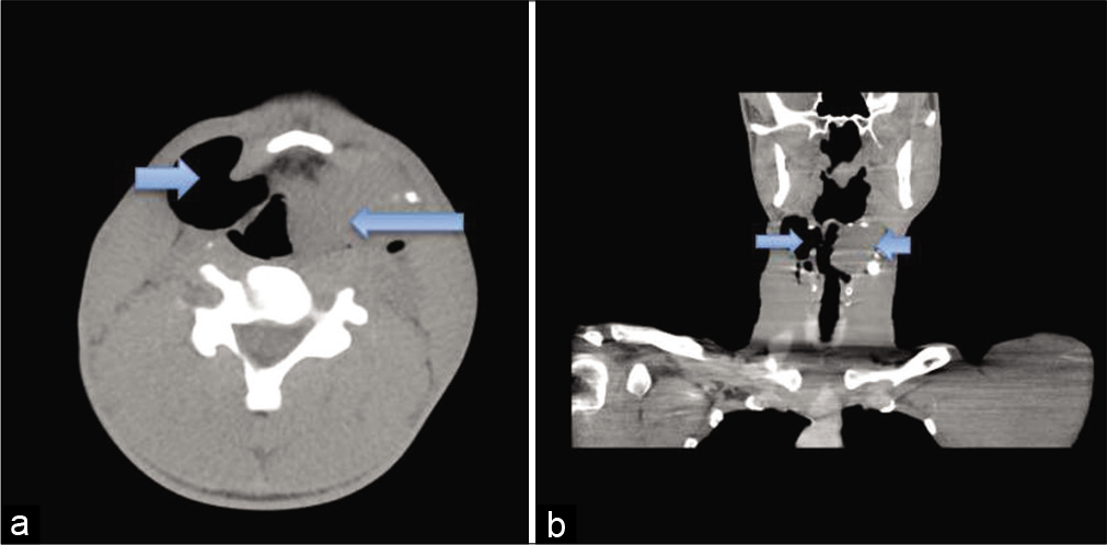 A 33-year-old man with features of upper airway obstruction with significant left sided neck mass. Computed tomographic images (a) axial and (b) coronal views revealed an enhancing lobulated ovoid isodense mass, with peripheral amorphous calcifications (likely displaced laryngeal cartilages), arising from the left border of the laryngeal vestibule. Resultant asymmetry and narrowing of the adjacent airway noted. The mass measures 4.12 cm × 3.80 cm in its widest coronal dimensions. There is a well-defined air-dense collection contralateral to the aforementioned mass (blue arrows).