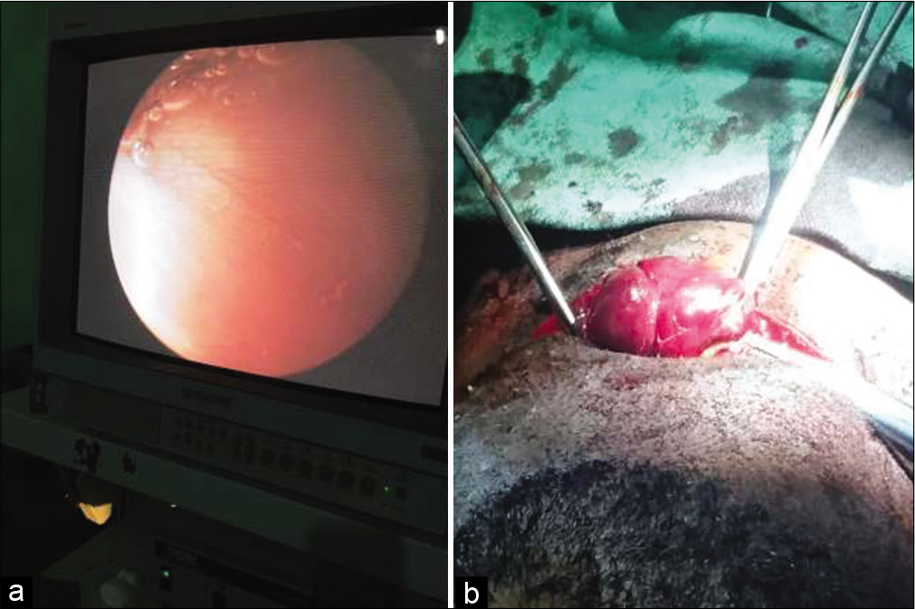 (a) Internal component of left mixed laryngopyocele. (b) Left laryngopyocele being dissected out.