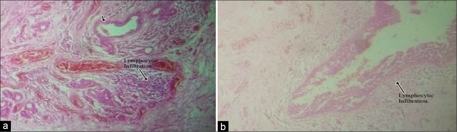 Plate 1: H&E ×100: Photomicrograph shows a cyst wall lined by ciliated respiratory epithelial-lined cysts with lymphocytic infiltration (black arrow) consistent with a laryngopyocele. Plate 2: H&E ×400: Photomicrograph shows a cyst wall lined by ciliated respiratory epithelial-lined cysts with lymphocytic infiltration consistent with a laryngopyocele.