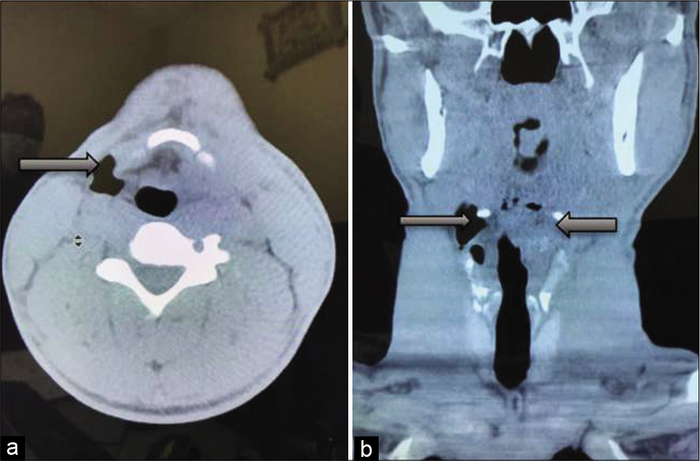 Post-excision of left laryngopyocele of a 33-year-old man who presented with upper airway obstruction due to left laryngopyocele and laryngocele. Computed tomographic images: (a) Axial and (b) coronal after surgery showing significant reduction in the size of right laryngocele and complete resolution of left laryngopyocele (black arrows).