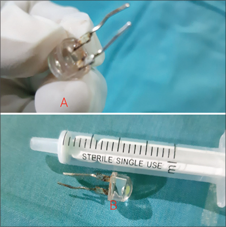 A LED bulb removed (A) via direct laryngoscopy (B) from a 7 year old girl following accidental inhalation.